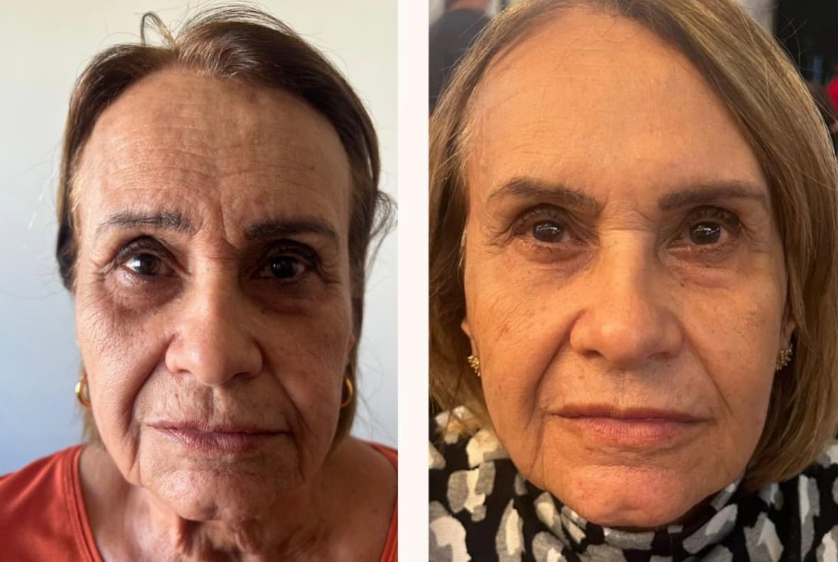 Bioestimulador de Colágeno